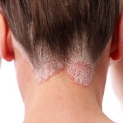 Psoriasis related image